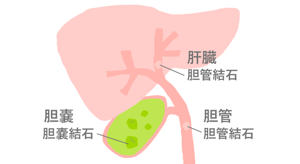 急性結石性胆嚢炎